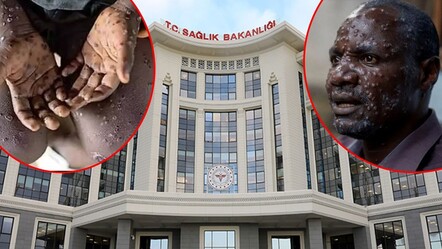 Merak ettiğiniz her şey burada! Sağlık Bakanlığı'ndan maymun çiçeği virüsü rehberi - haberler