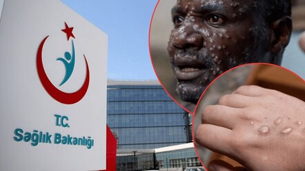 Sağlık Bakanlığı'ndan yeni rehber! Maymun çiçeği virüsü nasıl anlaşılır? Virüs nasıl bulaşır?  İşte detaylar... - gundem