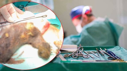 Hatay'da Rapunzel sendromlu genç kızın karnından 2 kilogram kıl yumağı çıktı - saglik