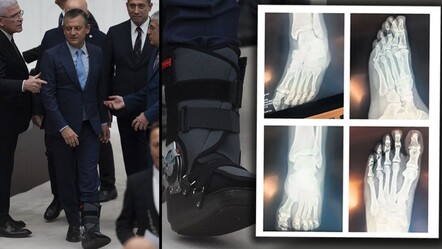 Özgür Özel'in ayağına ne olduğu merak konusuydu! Röntgen filmi ortaya çıktı - gundem