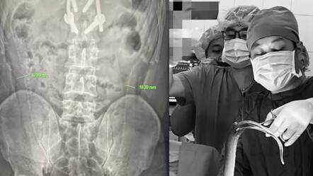 Şaşırtan olay! Adamın anüsünden yılan çıktı - gundem