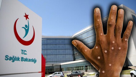 Türkiye'de ilk maymun çiçeği karantinası Ankara'da mı uygulandı? Resmi açıklama geldi - gundem