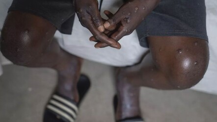 Uzman isimden maymun çiçeği virüsü hakkında önemli açıklama - gundem