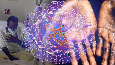 Maymun çiçeği virüsünde çarpıcı detay! Vakaların birçoğu çocuk - dunya