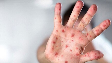 İstanbul İl Sağlık Müdürü'nden M çiçeği açıklaması - saglik