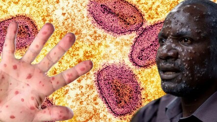 Maymun çiçeği virüsüyle ilgili korkutan açıklama! Ölen kişi sayısını duyurdular - gundem