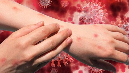 'Acil durum' ilan edilmişti! Nijerya'da M çiçeği vaka sayısı 48'e yükseldi - gundem