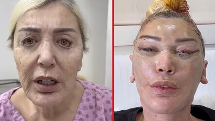 Estetik nedeniyle yüzü deforme olmuştu! Seda Sayan’ın ablası Nursel Sayan’ın son hali ortaya çıktı - magazin