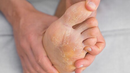 Yaş maya uygulaması, mantar problemleri için doğal bir çözüm olarak kullanılabilir - SAĞLIK