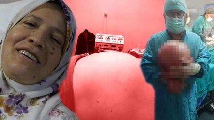 Karnı hamile gibi şişti, gerçek hastaneye gidince ortaya çıktı! 47 yıllık doktorun hayatında bir ilk - saglik