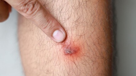 Siğil nedir? Belirtileri ve kesin çözüm yöntemleri  - saglik