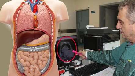 Türkiye ve dünyada bir ilk! ‘Giresun Sendromu’ literatüre geçti... Tüm organları ters dönmüş - saglik