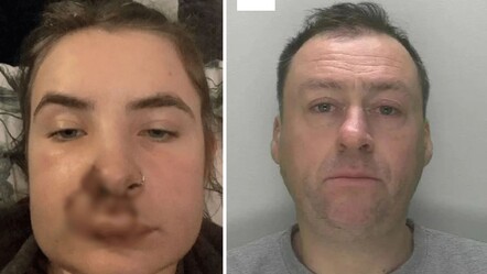 Otobüste korkunç saldırı! Genç kızın yüzünü ısırdı, 50 dikiş atıldı - dunya