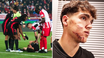 Barcelona'nın yıldızı Pau Cubarsi kanlar içinde yerde kaldı! Yüzüne 10 dikiş atıldı - spor