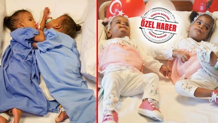 Bedenleri ayrıldı ama kalpleri bir! 18 ay yapışık yaşayıp 9 saatte ayrıldılar - saglik