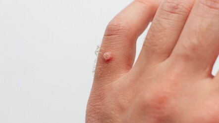 Siğil neden çıkar? Siğilin sebepleri ve çeşitleri - saglik