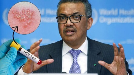 HSV-2 nedir, nasıl bulaşır, ölümcül mü? Dünya Sağlık Örgütü Herpes virüsü için uyarıda bulundu! - saglik