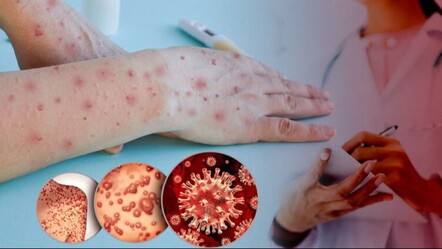 Maymun çiçeği virüsü Avrupa'da yayılıyor: Almanya'da eğitime ara verildi! - saglik