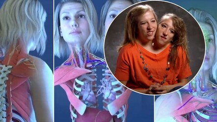 Dünyanın en ünlü yapışık ikizi vücut yapılarını paylaştı! Abby ve Brittany Hensel görenleri şaşkına çevirdi - saglik