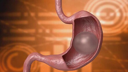 Yutulabilir mide balonu yasaklandı! Gerekçesini uzman isim açıkladı - saglik