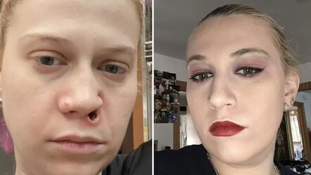 Uyuşturucu burnunu eritti! 15 operasyon geçirmek zorunda kaldı  - gundem