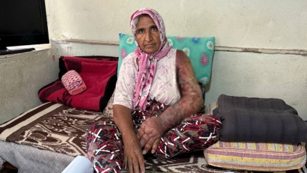 Böylesi görülmedi! Kolundan vücuduna uzandı: 4 çocuk annesi kabusu yaşıyor - Yaşam