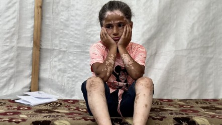 Yanı başına bombalar yağdı, korkudan hastalığa yakalandı! Gazzeli Lana yürek dağladı: Savaştan önce çok güzeldim - Dünya