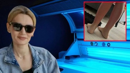 Solaryumda unutuldu, hastanelik oldu! Vücudunda ciddi yanıklar oluştu - Sağlık