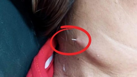Doktorlar bile şaştı! Yuttuğu balık kılçığı boynunu delip geçti - Dünya
