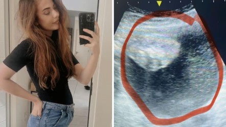Karnındaki şişkinlik sebebiyle başvurmuştu! 3 günde 5 santimetre: Acı gerçek ortaya çıktı - Dünya