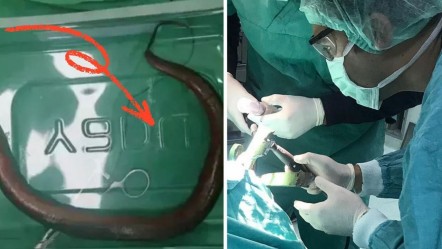 Karın ağrısı şikayetiyle başvurmuştu! Karnından çıkan doktorları hayrete düşürdü: Adeta yüzüyor - Dünya