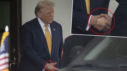 Trump’ın makyajla kapatılan elindeki morluk dikkat çekti! Beyaz Saray'dan açıklama geldi - Dünya