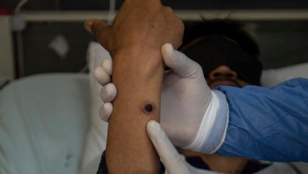 Gizemli virüs ülkeyi esir aldı! Avustralya'da alarm zilleri çalıyor - Dünya