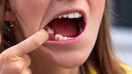 Diş eksikliği deyip geçmeyin: Pek çok hastalığı tetikleyebilir - Sağlık