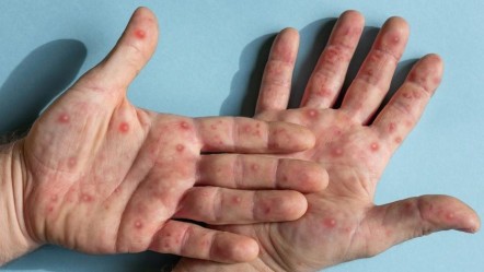 Bir ülkede 'Mpox' kabusu! İlk ölüm kayıtlara geçti - Dünya