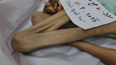 Bu acıya yürek dayanmaz... Görenlerin içini sızlattı! 27 yaşında açlıktan 15 kiloya düştü - dunya