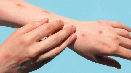 Mpox tehlikesi büyüyor! Vaka sayısı 300'ü aştı, can kaybı var - Dünya