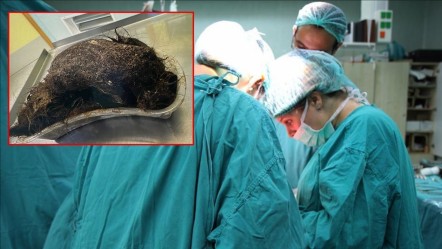 Karın ağrısı şikayetiyle gitmişti! Midesinden çıkanlar doktorları bile hayrete düşürdü: Gider deliği gibi... - Dünya