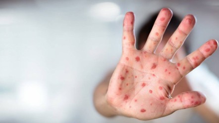 Çocuklarda yaz hastalıkları artıyor! Döküntü ve pullanmaya özellikle dikkat - Sağlık