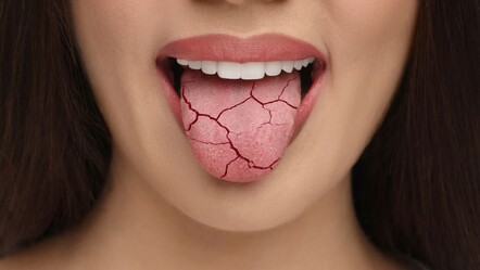 Dil çatlağı vitamin eksikliğinin belirtisi! 10 kişiden ikisinde görülüyor - Sağlık