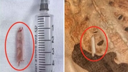 Duyanlar kulaklarına inanamıyor! 22 yıl boyunca kalçasında termometreyle yaşadı - Dünya