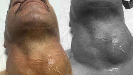 Nefes darlığı yaşıyordu… Boynu bir anda şişti, gerçek hastanede ortaya çıktı - Sağlık