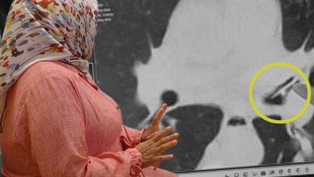 Öksürükten uyuyamıyordu… 'Astımsın' hatta 'kansersin' dediler, sebebi çok başka çıktı - Sağlık