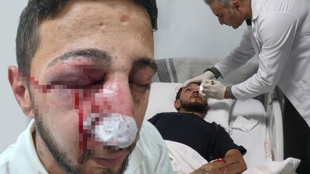 Düğünde havai fişek faciası: Gözünde patladı! "Bitti zannetmiştim" - 3. Sayfa