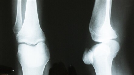 Diz Osteoartriti hastalarına yeni tedavi yöntemi! Düşük radyasyonla ağrılar azalıcak - Sağlık
