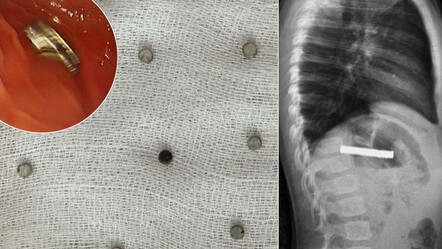Kimse nasıl olduğunu anlamadı! Küçük çocuğun boğazından 19 mıknatıs çıktı - Yaşam