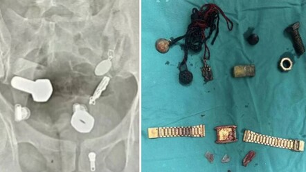Karın ağrısı şikayetiyle gitmişti, midesinden öyle şeyler çıktı ki... Doktorlar bile şaşkına döndü - Sağlık