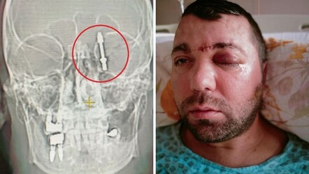 Beynine saplanan implant hayatını kabusa çevirdi! Diş hekimine verilen cezaya isyan etti - 3. Sayfa
