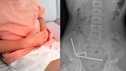 Oyun sanmıştı, kabusa döndü! 13 yaşındaki çocuk 200 mıknatıs yuttu - Dünya