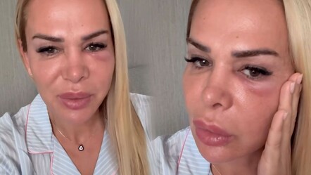Yüzü şişince ‘darp edildi’ denildi, Nagihan Karadere gerçeği açıkladı - Magazin